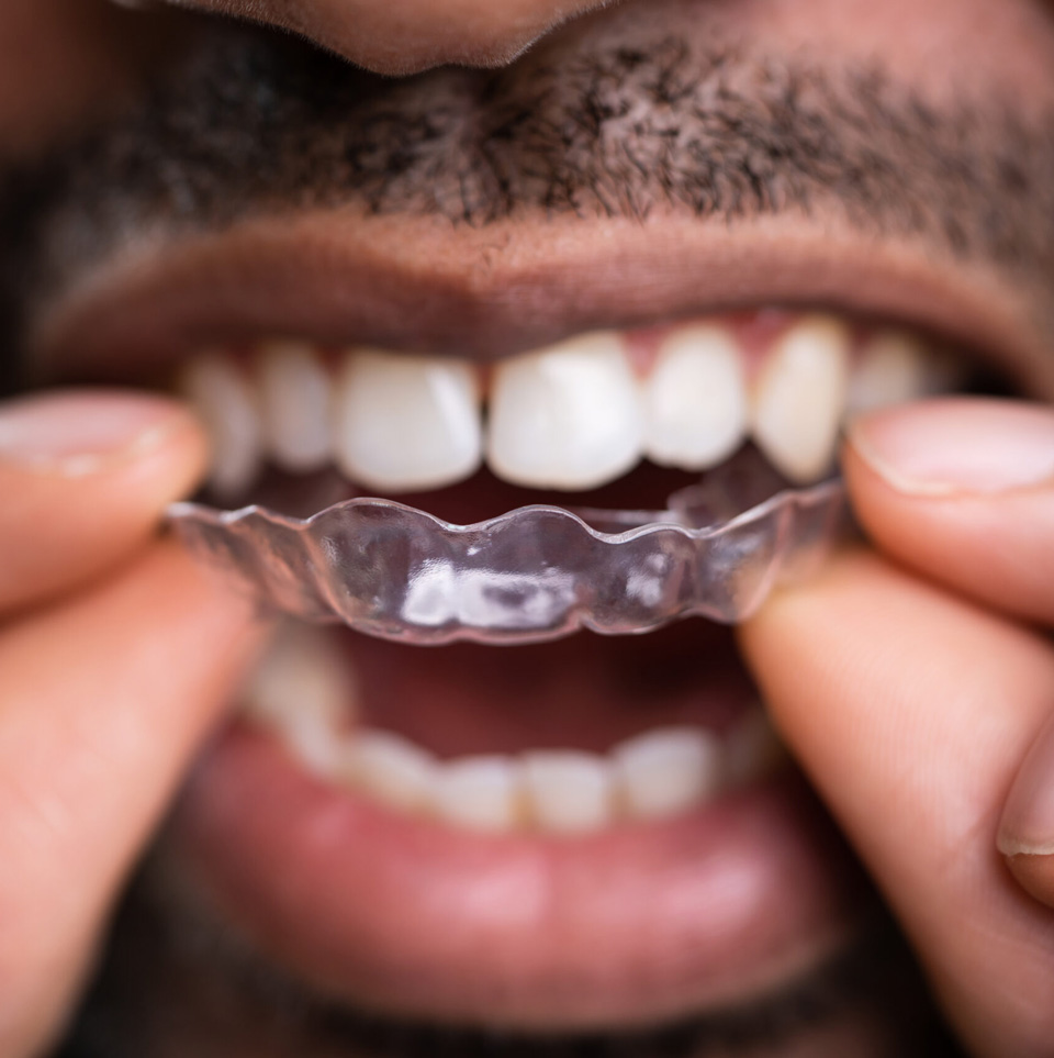 Benefits of Invisalign® treatment